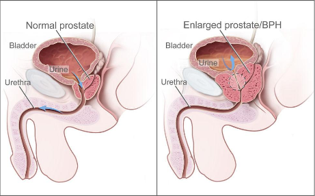 funcția prostatei prostate cancer urine test results